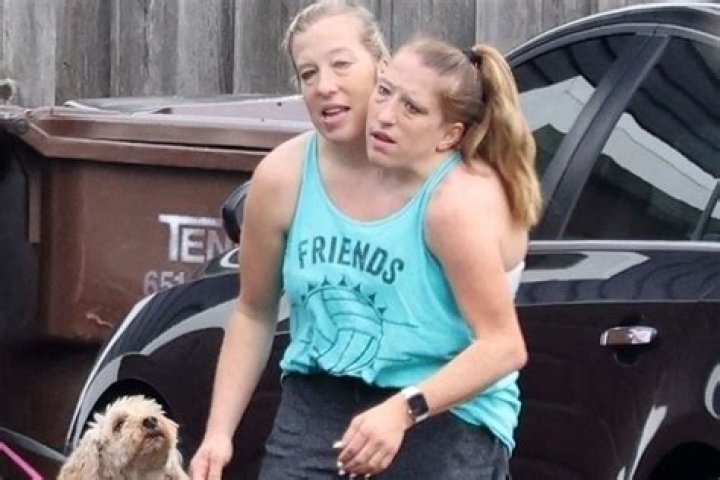 Are Abby and Brittany Hensel Still Alive? What Happened to Them?