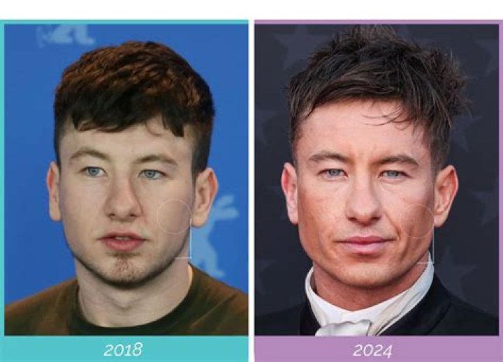 Barry Keoghan and Plastic Surgery Truth Regarding Barry Keoghan's