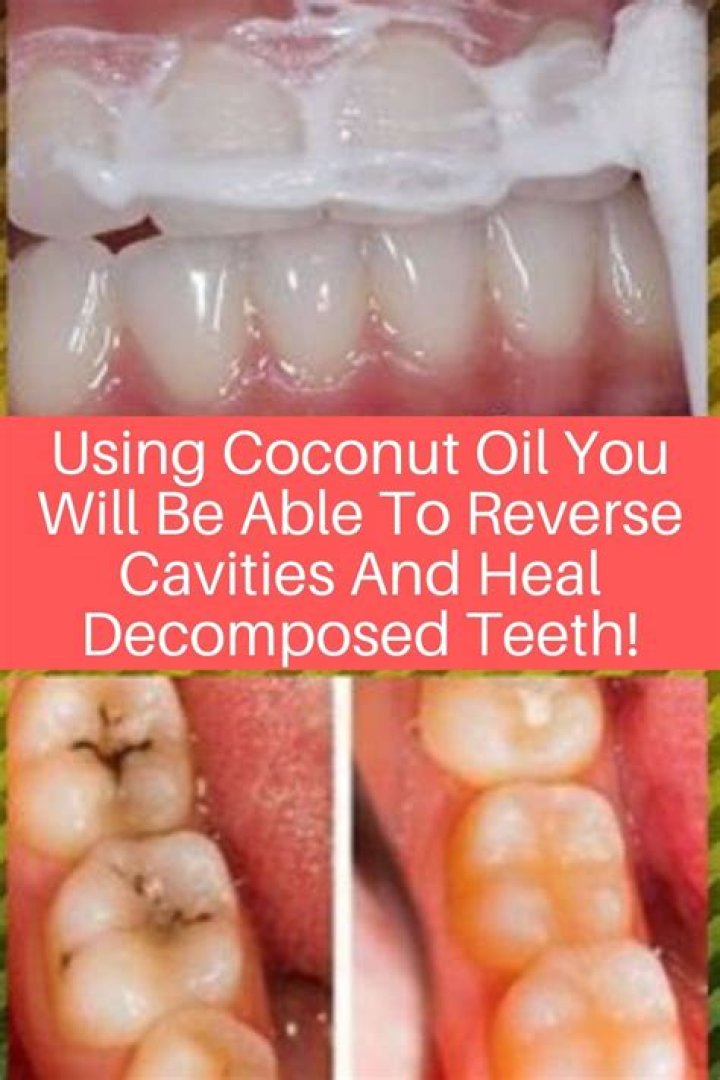 Can coconut oil heal a cavity?