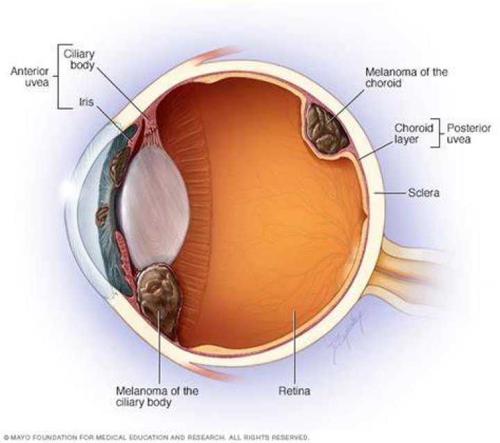 Can eye melanoma be cured?