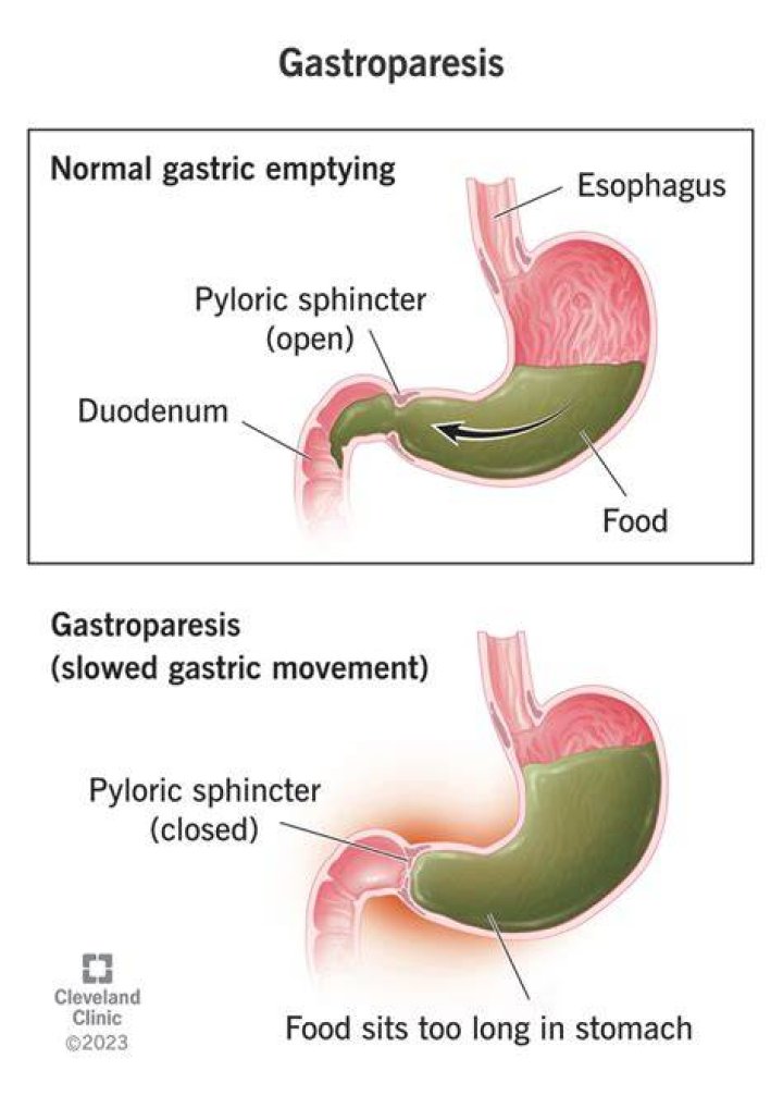 Can gastroparesis heal itself?