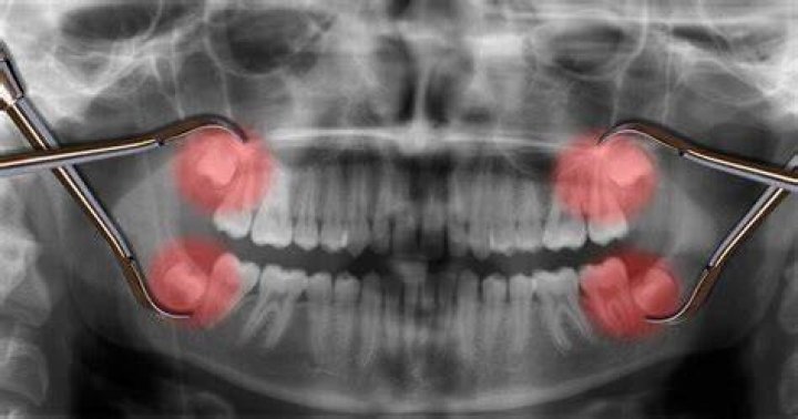Do they give you anesthesia for wisdom teeth?