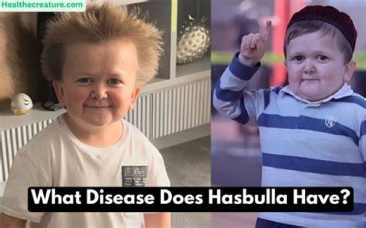 Hasbulla Disease And Illness What Treatment Is He Getting?