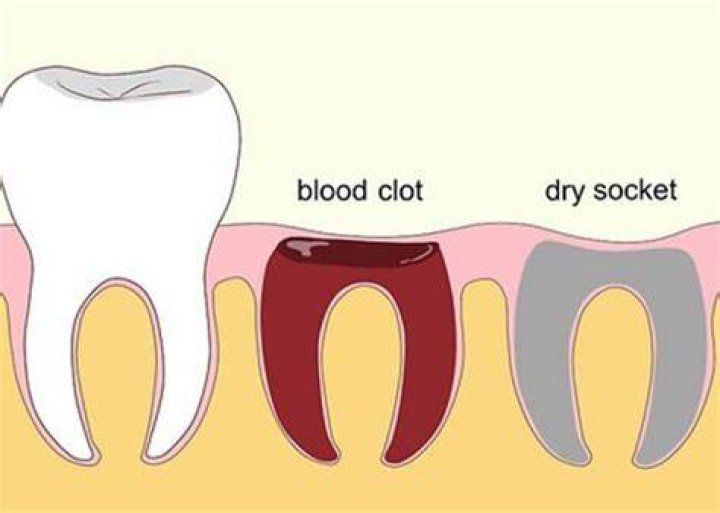 How do dentist treat dry socket?