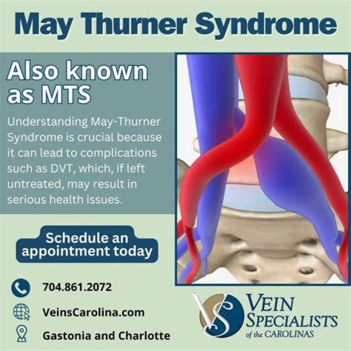Icd 10 May Thurner Syndrome Captions Update Trendy