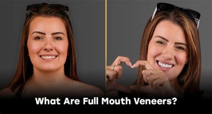 Is it worth getting veneers in Turkey?