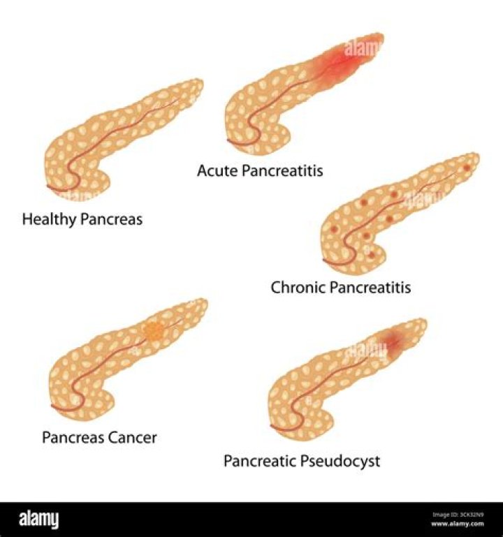 Is pancreatitis serious?