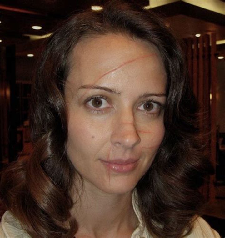 Jessica Dube&rsquo;s Scar How Is It Now? Face Injury & 2023 Update!