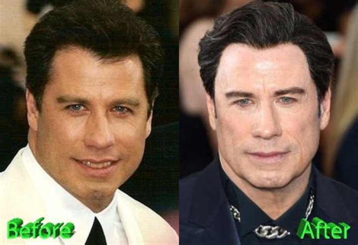 John Travolta Plastic Surgery Facelift, Botox, Hair transplant