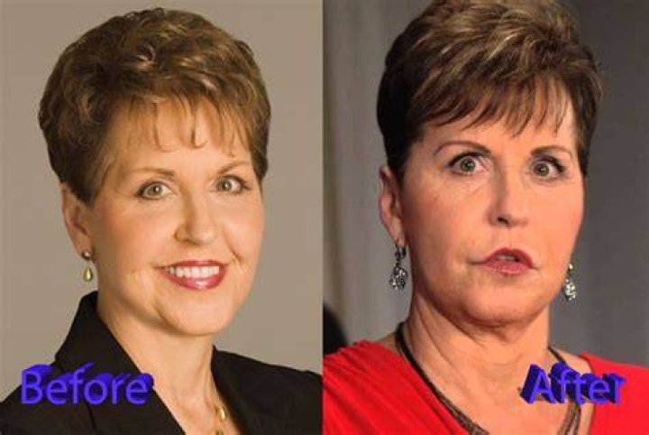 Joyce Meyer Plastic Surgery Before And After JoyceMeyerPlasticSurgery