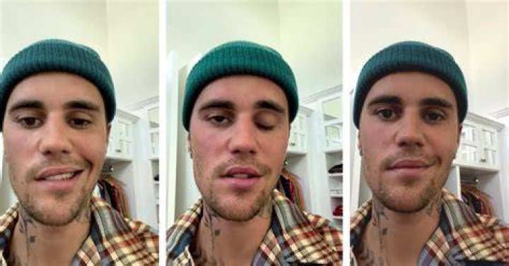 Justin Bieber suffering facial paralysis due to Ramsay Hunt syndrome