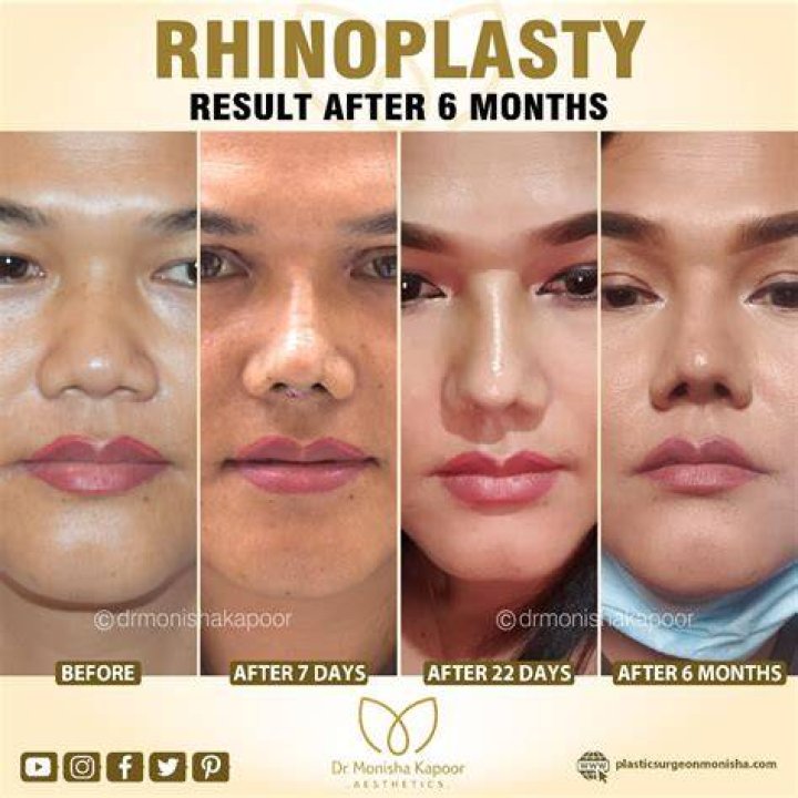My Rhinoplasty Procedure Story — Nose Before and After Photos Allure