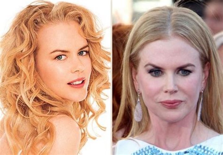 Nicole Kidman plastic surgery Celebrity Plastic Surgery celebrity