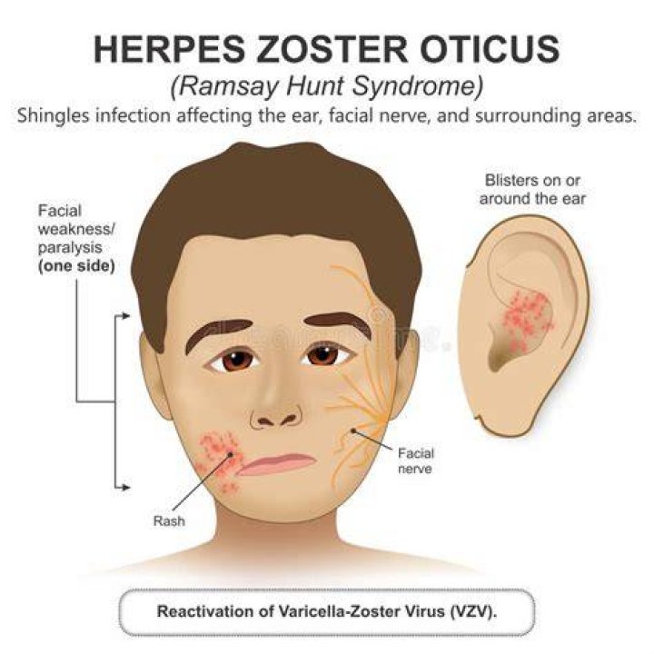 Ramsay Hunt Syndrome (Herpes Zoster Oticus) Causes & Treatment