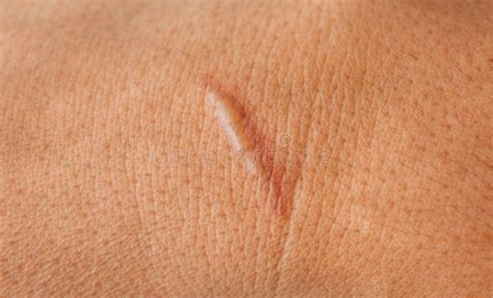 Scar On Human Skin Scar Or Scar After Kidney Surgery RoyaltyFree Stock