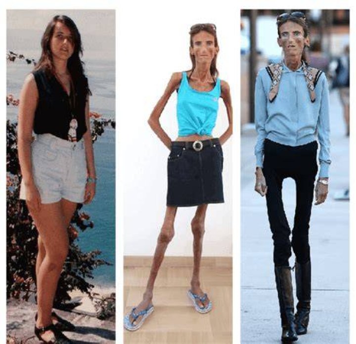 Skinniest person in the world some of the thinnest people