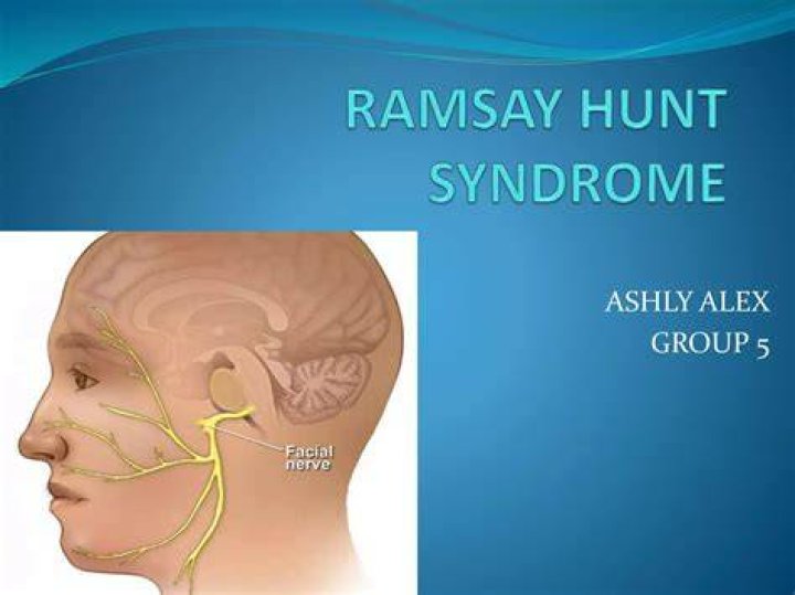 What is Ramsay Hunt syndrome, the rare disorder affecting Justin Bieber