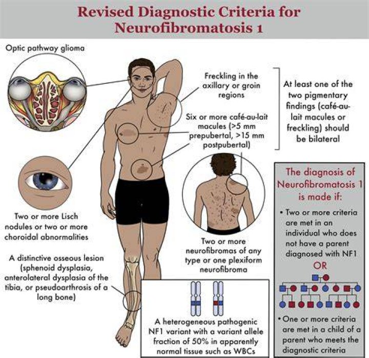 What is the death rate of neurofibromatosis?