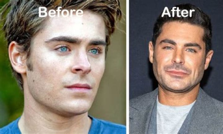 Zac Efron Before and After Has He Had Any Plastic Surgery? Zac efron